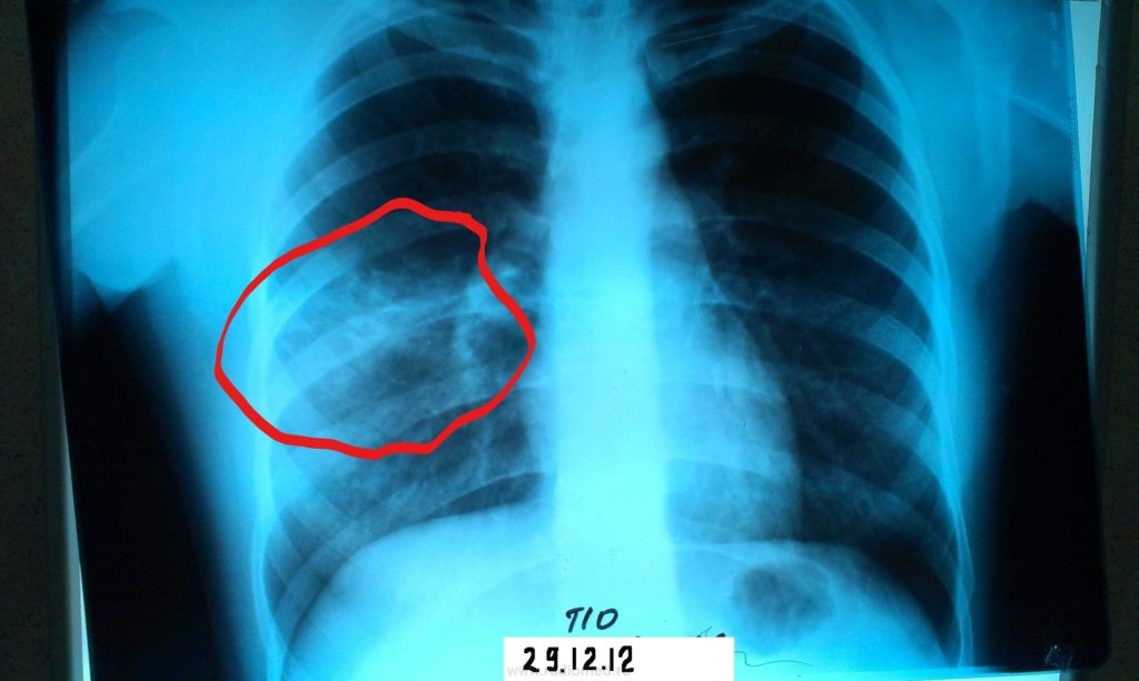 Пневмония справа