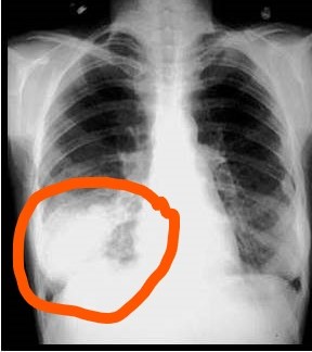 Как отличить пневмонию и туберкулез: рентген.