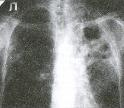 Различные виды фиброзно-кавернозного туберкулеза легких