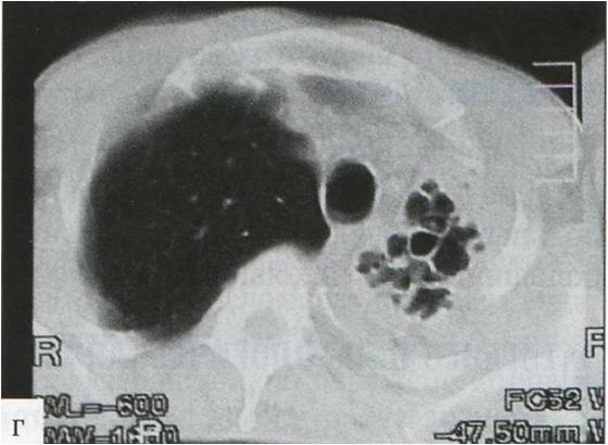 Казеозная пневмония слева с распадом
