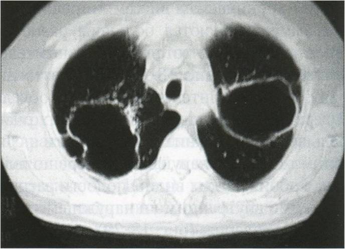 На первой рентгенограмме - хронический диссеминированный туберкулез с распадом, на второй - распад при хроническом диссеминированном туберкулезе по типу "штампованных каверн"