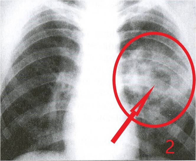 Более распространенная форма туберкулеза: инфильтративный туберкулез в распадом