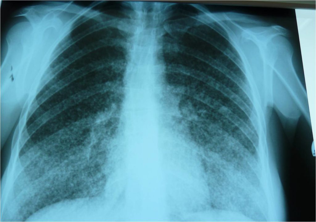 Таким образом милиарный туберкулез легких выглядит на рентгенограмме.
