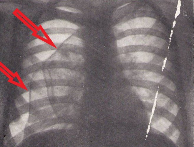 Спонтанный пневмоторакс справа: как это выглядит изнутри и на рентгенограмме.