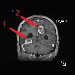 Представлена серия МРТ с единичными и множественными туберкулезными абсцессами головного мозга